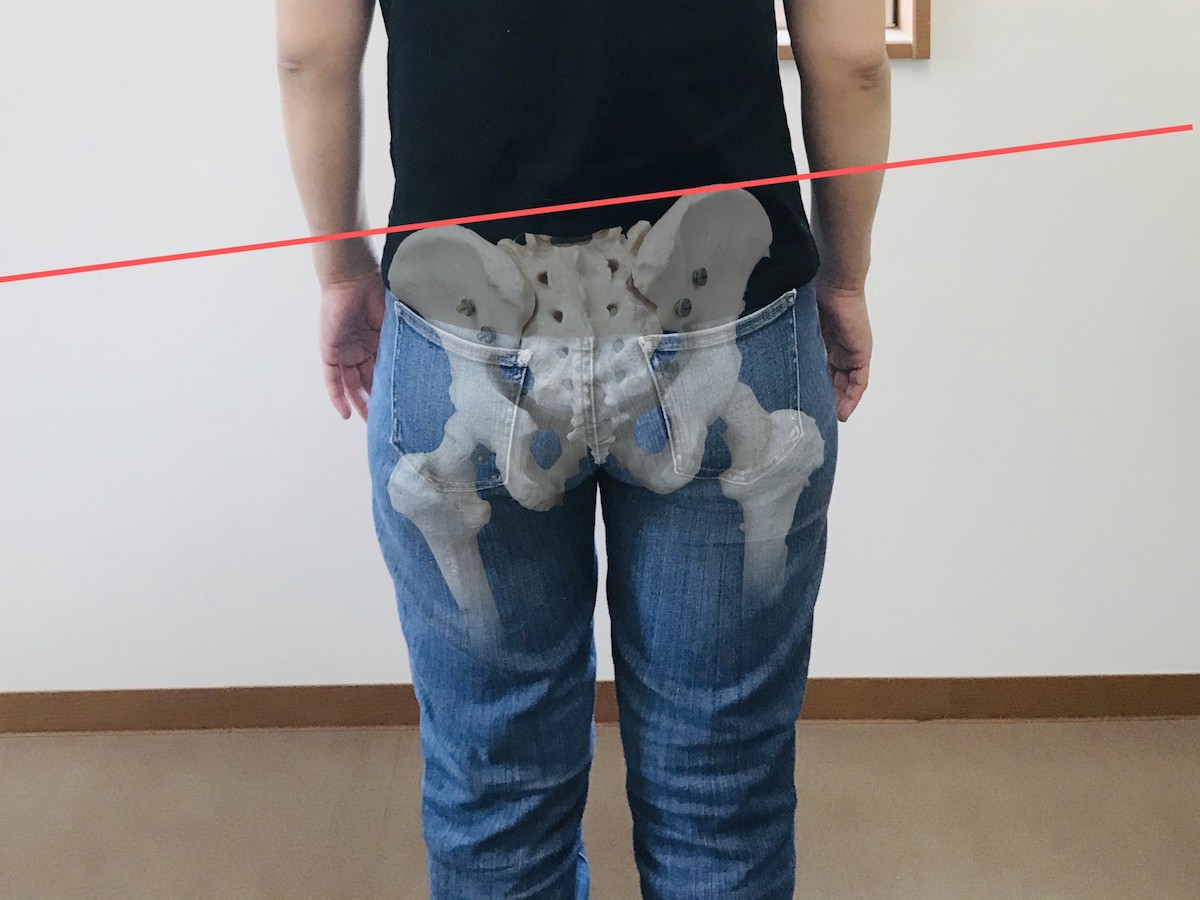 骨盤の歪みが引き起こす腰痛