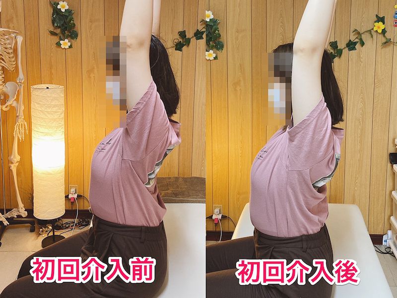 北区王子整体サロンてぃ〜だに来院された肩の痛みでお悩みの20代女性