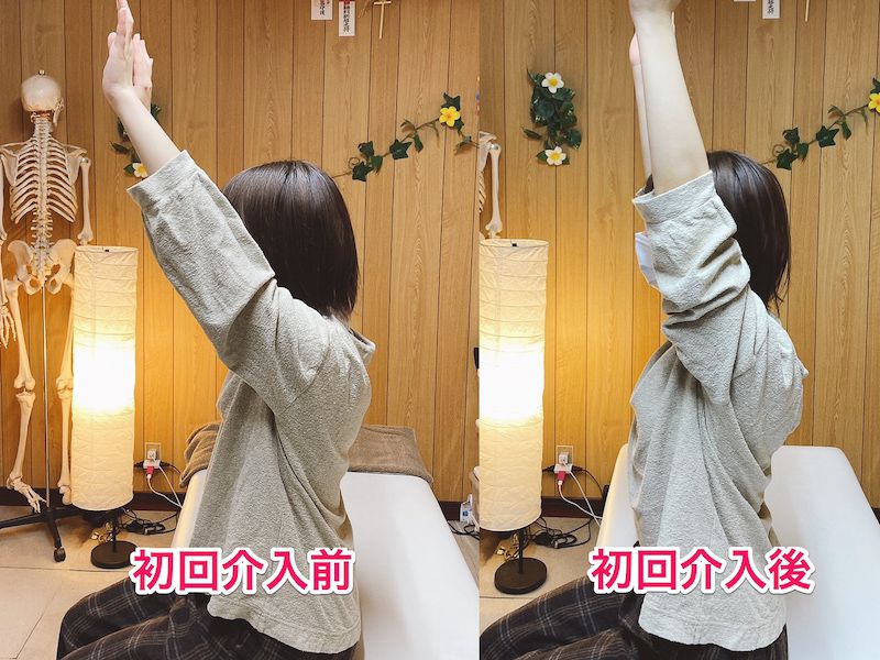 北区王子整体サロンてぃ〜だに来院された頸椎椎間板ヘルニアでお悩みの20代女性